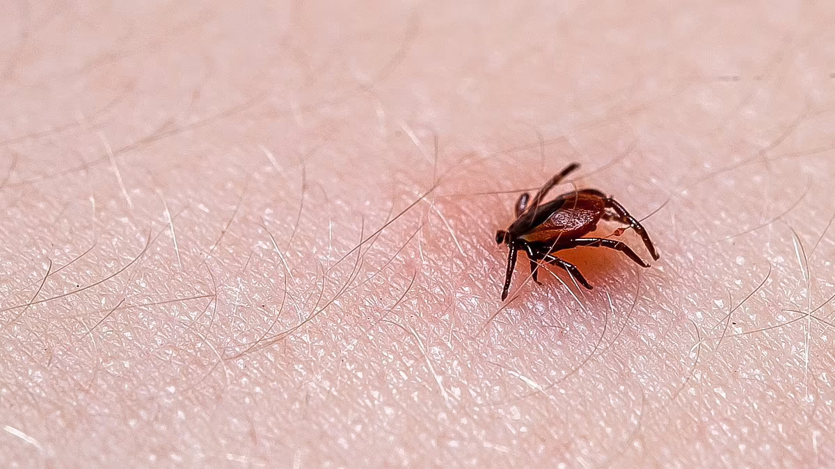 Tick-Borne Disease Strikes Thousands in West Virginia