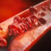 Spurring Opportunity for New Treatment Approaches: Scientists Find Cancer-Like Features in Atherosclerosis