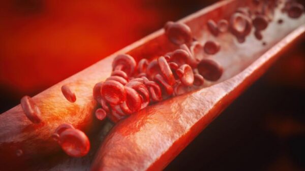 Spurring Opportunity for New Treatment Approaches: Scientists Find Cancer-Like Features in Atherosclerosis