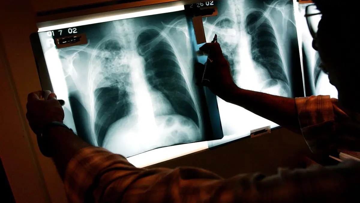 Officials Declare Health Emergency as California Tuberculosis Outbreak Kills 1, Infects 14