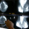 rising breast cancer rates at younger ages