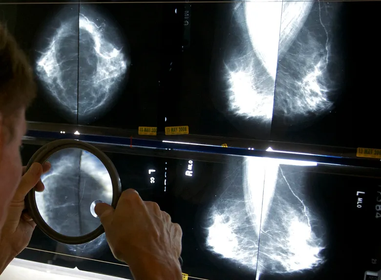 rising breast cancer rates at younger ages