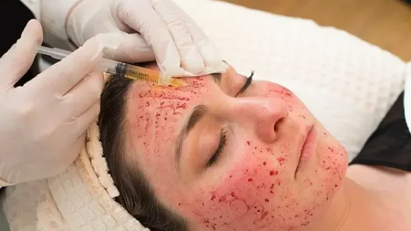 Three Women Infected with HIV by 'Vampire Facials': How It Happened