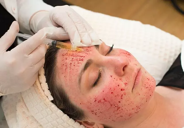 Three Women Infected with HIV by 'Vampire Facials': How It Happened